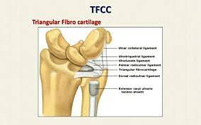Forced ulnar deviation and positive ulnar variation carry associations with injuries to the tfcc. Tfcc Triangular Fibrocartilage Complex Injuries Mht