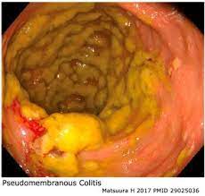 A small number of healthy people naturally carry. Clostridioides Prev Clostridium Difficile Emcrit Project