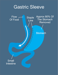 Gastric Sleeve Vs Gastric Bypass Overview Gastric Sleeve Gastric Sleeve Surgery Sleeve Surgery