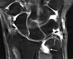 Triangular fibrocartilage complex injury exercises or tfcc injury exercises. Mr Arthrography Is Slightly More Accurate Than Conventional Mri In Detecting Tfcc Lesions Of The Wrist Sogacot