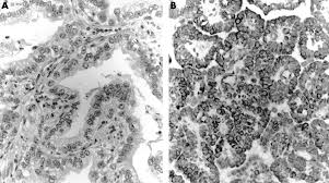 Immunohistochemistry In The Distinction Between Malignant Mesothelioma And Pulmonary Adenocarcinoma A Critical Evaluation Of New Antibodies Journal Of Clinical Pathology
