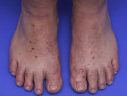 Find out about hand, foot, and mouth disease (hfmd) treatment, symptoms, diagnosis, and infection during pregnancy. Hand Foot And Mouth Disease Dermnet Nz