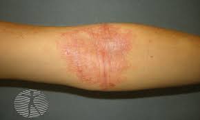 Image result for Atopic eczema atopic dermatitis