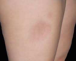Image result for Panniculitis