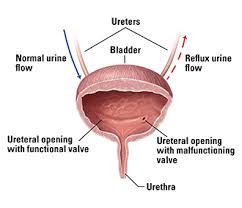 Vesicoureteral Reflux Vur Niddk