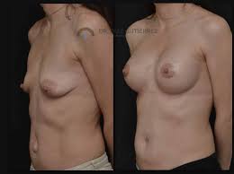 Fotos antes y después Abdominoplastia Madrid | Doctor Díaz Gutiérrez