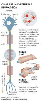 Maybe you would like to learn more about one of these? Controlar La Inflamacion Clave Para Evitar El Empeoramiento De La Esclerosis Multiple Salud