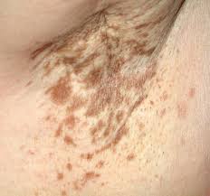 Image result for Diffuse Hyperpigmentation