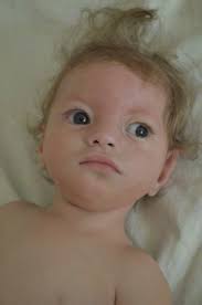 Wolf-Hirschhorn Syndrome: Clinical and Genetic Study of 7 New Cases, and  Mini Review