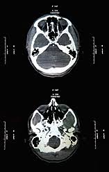 The person lies on a table that moves through a scanning ring, which looks like a large doughnut. Ct Scan Report Of Head Skull Close Up Stockphoto
