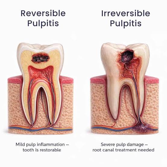 Pulpitis Treatment (irreversible, reversible) Glendale, Queens, NY