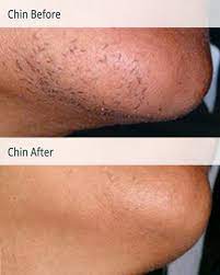 At the time, a rep at the location, in. Laser Hair Removal For Pcos Milan Laser Hair Removal