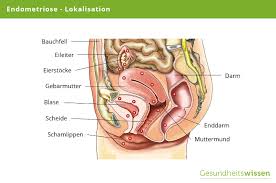 Endometriose Ursachen Symptome Diagnose Behandlung