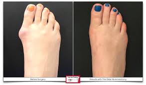Using preventive measures, including flexibility and strengthening exercises, you may be able to slow or stop the progression of the bunion, thus avoiding surgical intervention that does not. Our Blog Foot First Podiatry Centers