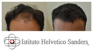 La tecnica microfue è il metodo più avanzato e all'avanguardia di trapianto di capelli. Trapianto Capelli La Scelta Del Miglior Chirurgo L Arena