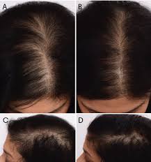 treating hair loss with platelet rich