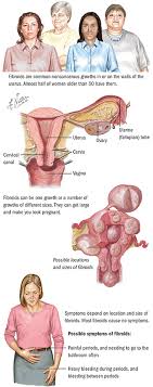 Fibroids are the most common indication for a hysterectomy 7). Fibroids Spectrum Health