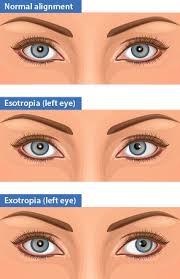 How To Treat Crossed Eyes Strabismus Eye Exercises Vision Eye Eye Health