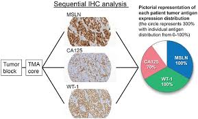 Researchers continue to test the therapy in clinical trials. Cancer Antigen Profiling For Malignant Pleural Mesothelioma Immunotherapy Expression And Coexpression Of Mesothelin Cancer Antigen 125 And Wilms Tumor 1 Abstract Europe Pmc