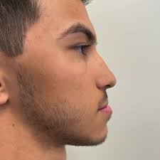 Jaw surgery, also known as...