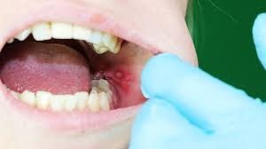 How To Identify Rashes And Other Lupus Skin Symptoms Everyday Health