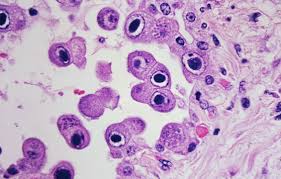 Jun 07, 2018 · seek immediate medical attention if you have these signs of infection: Infected Cut Signs Treatment More Physicianone Urgent Care