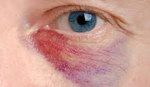 Comment Soigner Un œil Au Beurre Noir Black Eye Remedies Eye Health Eye Health Remedies