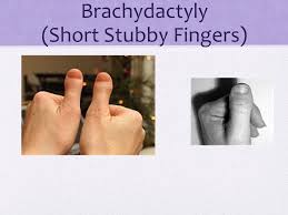 Some people have brachydactyly type d or clubbed thumbs which is a genetic condition and means your thumb or thumbs may be very short and wide. Trait Survey Widow S Peak Hitch Hiker S Thumb Brachydactyly Short Stubby Fingers Ppt Download