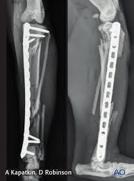Image result for Fracture Complication