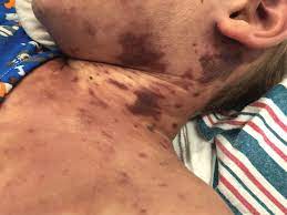Within hours of onset of symptoms, it may lead to shock and even death if prompt and appropriate medical care is not given. Purpura Fulminans And Refractory Shock In A Child