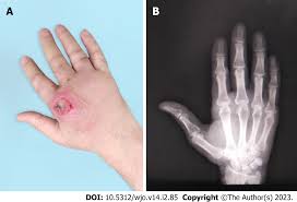 Image result for Septic Joint