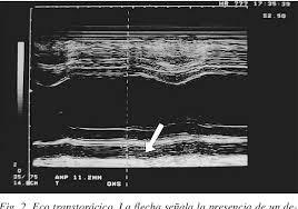 Como una inflamación del miocardio. Miocarditis Aguda Por Virus De La Varicela Semantic Scholar