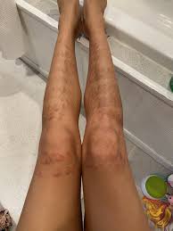 Tackle troublesome patches of hair and leave your skin feeling silky smooth with laser hair removal deals in orlando. Horrible Burns And Hypopigmentation After Laser Hair Removal Help Laser Hair Removal Hairtell Hair Removal Forum By Andrea James