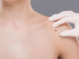 14.05.2021 · checking for skin cancer symptoms. Melanoma Symptoms Treatments And Other Facts