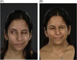 Reanimation of the brow and eye in facial paralysis: Review of the  literature and personal algorithmic approach