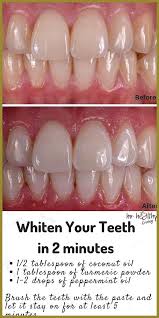 Pin On Teeth Whitening