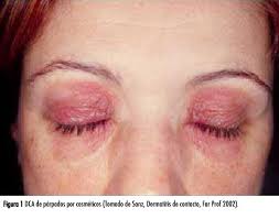 Image result for dermatitis contacta allergica