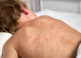 Image result for measles