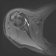 Webmd's shoulder anatomy page provides an image of the parts of the shoulder and describes its the shoulder is one of the largest and most complex joints in the body. Slap Tear Radiology Case Radiopaedia Org