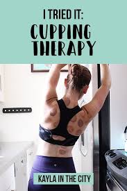 I Tried It Cupping Therapy Kayla In The City Cupping Therapy Benefits Of Cupping Fitness Blog