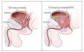 1a), of missing an aggressive cancer (fig. Benign Prostate Enlargement Bph Premier Healthcare Germany