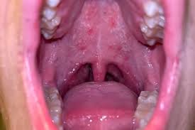 Image result for Canker sores symptoms roof of the mouth