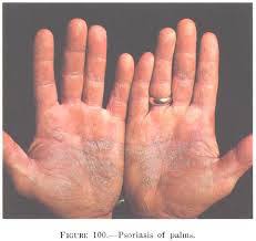 The patches develop in places where skin touches skin, such as the armpits. What Is Psoriasis Symptoms Causes Treatment Study Com