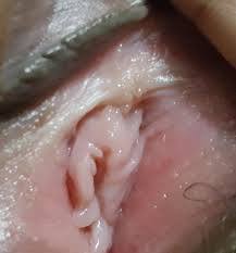 How vaginal discomfort is treated depends on what condition is causing the problem My Urethral Opening And Vaginal Opening Looks Like Idk What Page 2 Sexual Health Forums Patient