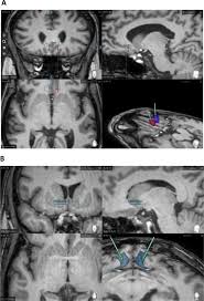 7 best clinics for schizophrenia treatment. Deep Brain Stimulation In Treatment Resistant Schizophrenia A Pilot Randomized Cross Over Clinical Trial Ebiomedicine