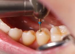You may not have any symptoms at first. Cavity Filling The Procedure Aftercare And Long Lasting Dentist In Santa Rosa