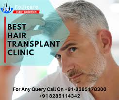 Get Successful Hair Transplant Surgery At Affordable Price Any Query Call On 91 82851 78300 82 In 2020 Facial Hair Transplant Hair Transplant Hair Solutions