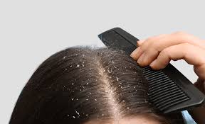 Image result for dry scabs on the head in children