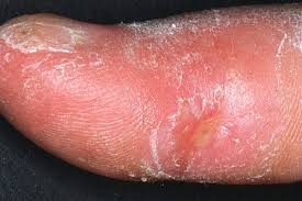 There are four different types of morphea, generalized morphea, pansclerotic morphea, linear morphea, and morphea of children. Systemic Scleroderma Wikipedia