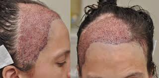 A report from the multidisciplinary androgen excess and. Cancer Patients Reconstructive Hair Transplant Update News Testimonial Mcgrath Medical